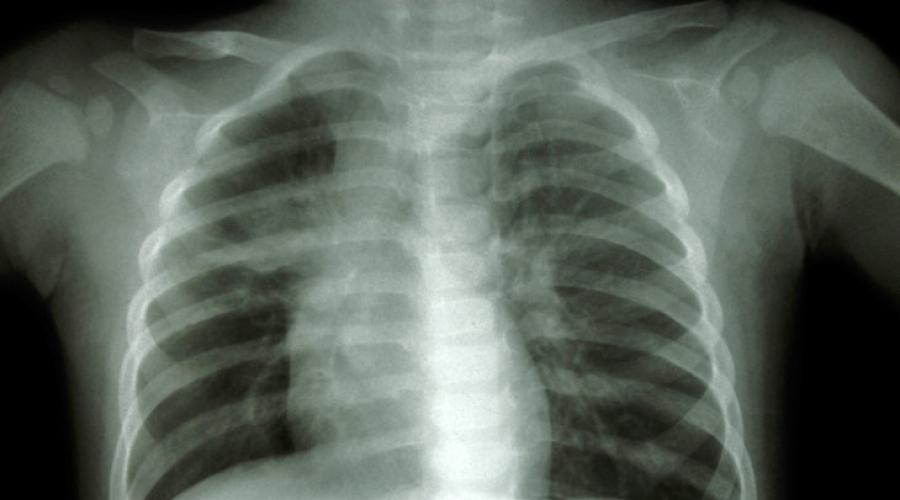 Как исключить туберкулез легких. Скелетный костной системы человека