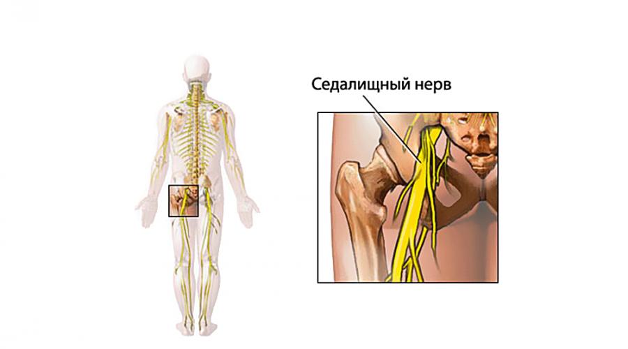 Защемление седалищного нерва: как снять и лечить воспаление нерва в поясничном отделе? Что делать, если седалищный нерв защемило. 