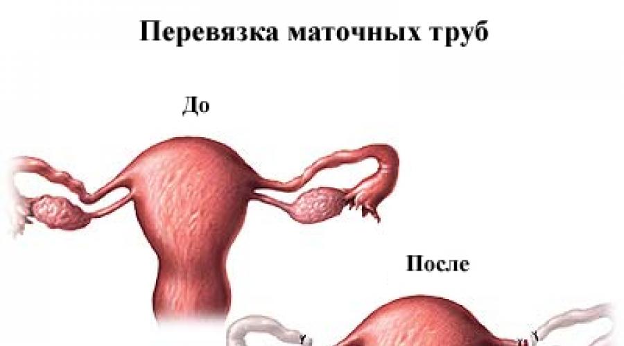 Женская стерилизация. Добровольная хирургическая стерилизация женщин