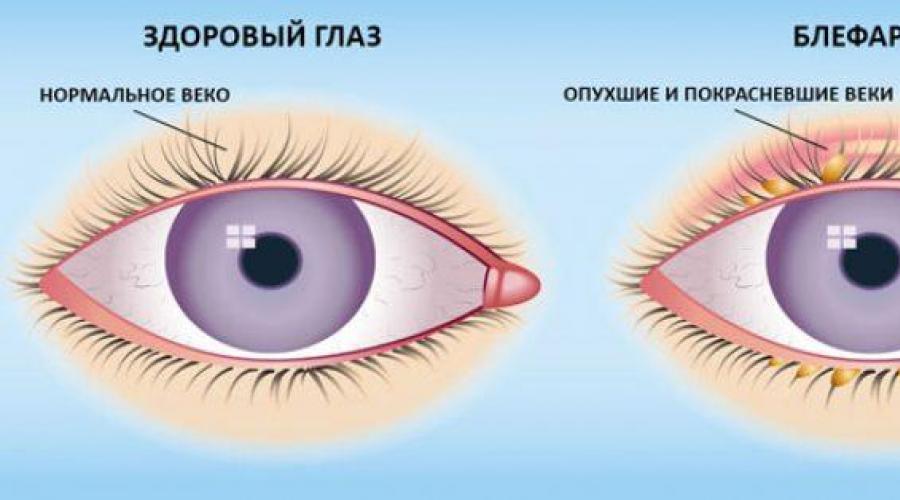 Капли для глаз Ципромед: боремся с инфекцией на «раз, два, три. Глазные и ушные капли Ципромед: инструкция по применению Ципромед ушные капли при беременности