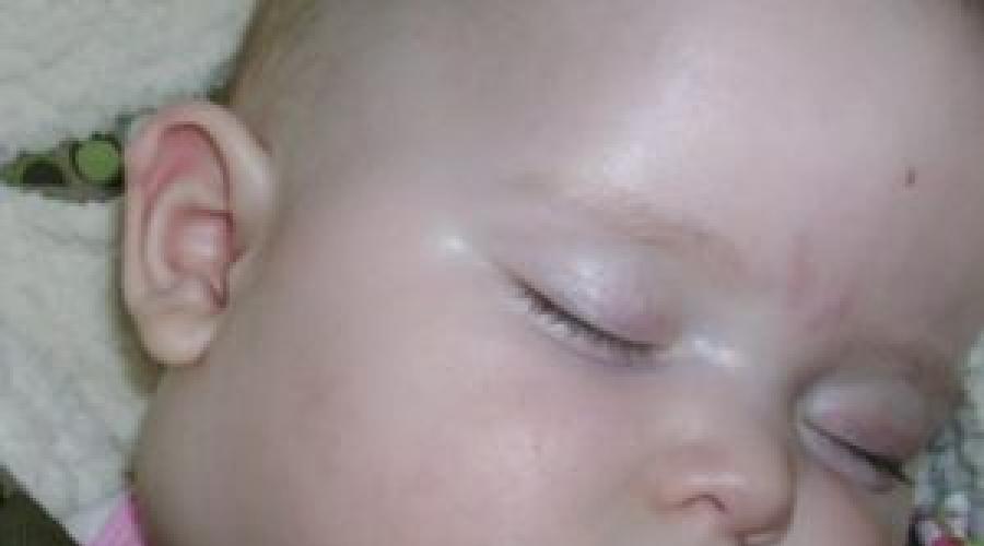 Частое воспаление лимфоузлов на шее у детей. Зачем нужны лимфоузлы и где они находятся? Что такое лимфоузлы