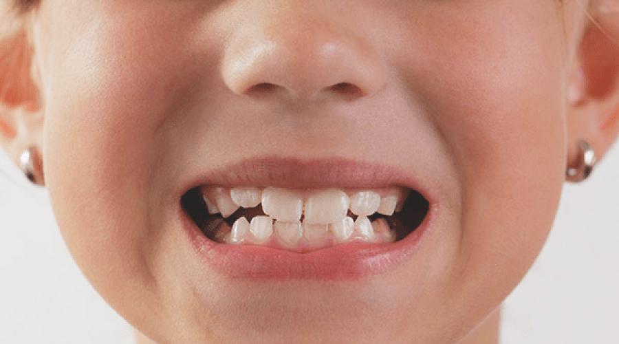 Витамины для укрепления зубов детям. Почему у ребенка плохая эмаль на зубах и что делать