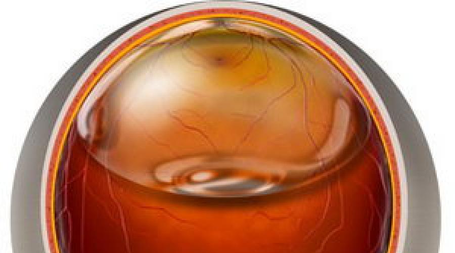 Осложнения при длительном пребывании силиконового масла в полости глаза (клинико-морфологическое исследование). Что важно знать об отслойке сетчатки Закачка силикона в глаз