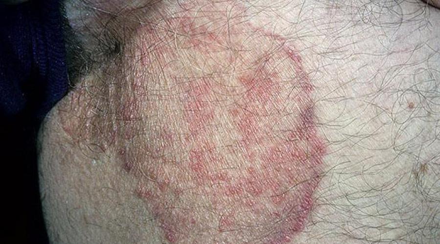 Дерматомикоз на лице. Дерматомикоз гладкой кожи: симптомы и лечение (фото)