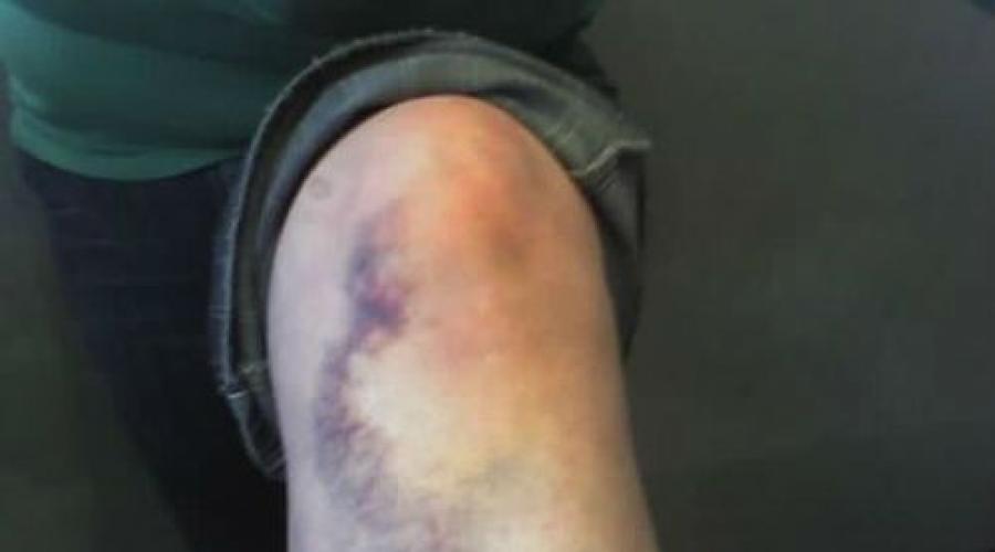 Повреждение суставной сумки колена. Диагностирование и методы лечения различных травм колена