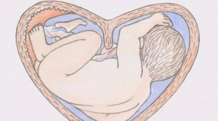 Седловидная форма матки как забеременеть. Седловидная матка и зачатие