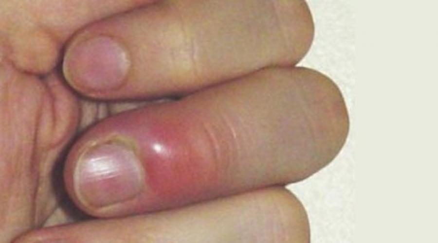 Панариций: лечение и возможные рецидивы. Панариций пальца — лечение и фото Мазь при воспалении пальца