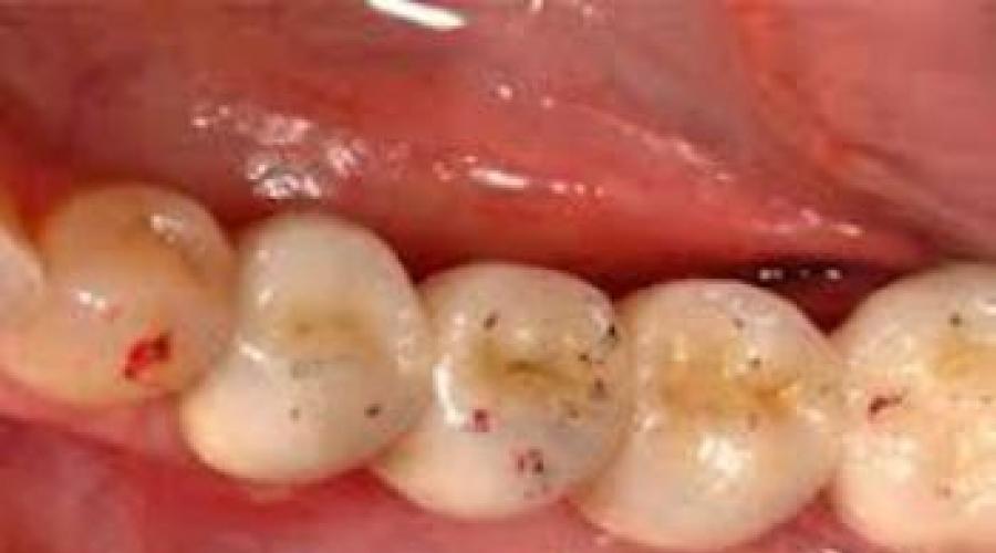 Темная точка на зубе: причины и устранение. На зубах черные точки: что делать