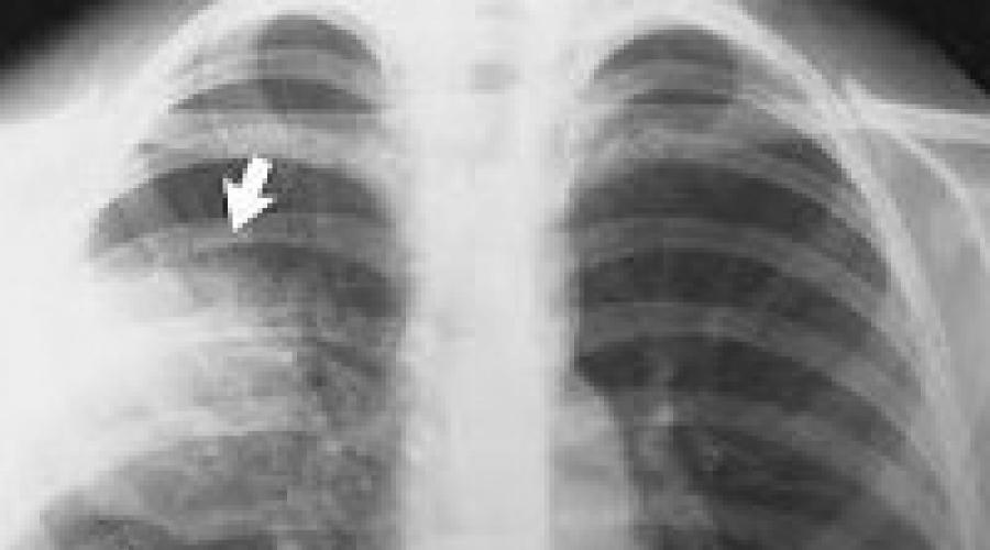 Основной рентгенологический признак пневмонии вызванной пневмококком. Признаки, диагностика и лечение пневмококковой пневмонии