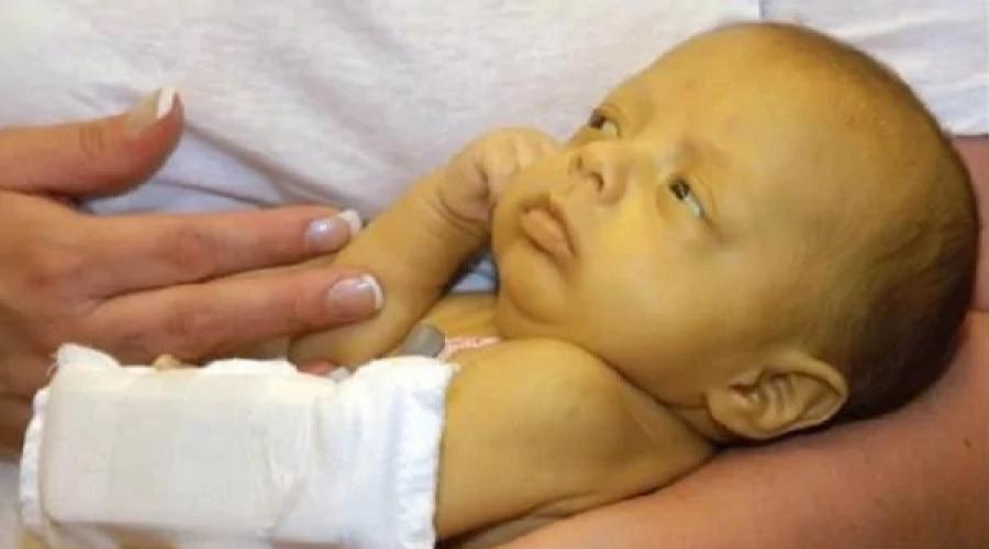 Почему ребенок рождается с желтухой. Основные причины физиологической желтушки