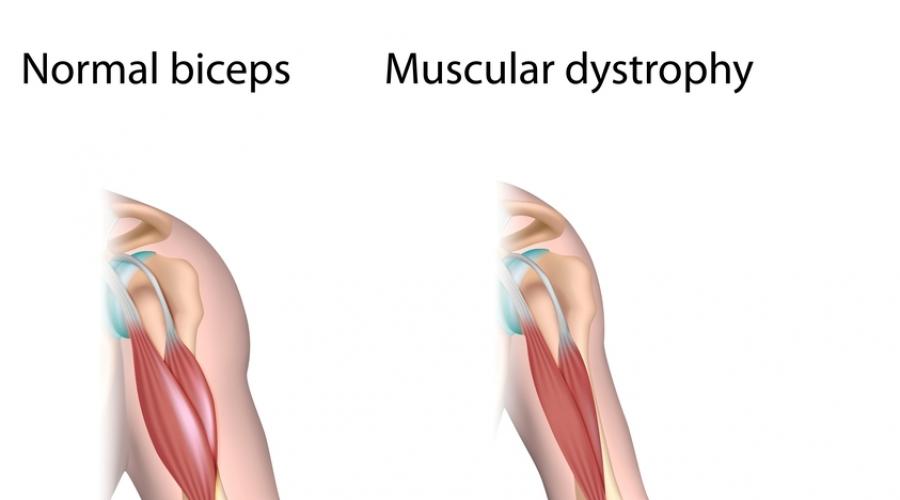 Причины, симптомы и лечение различных форм миопатии. Мышечные патологии: основные причины возникновения миопатии Миопатия ног