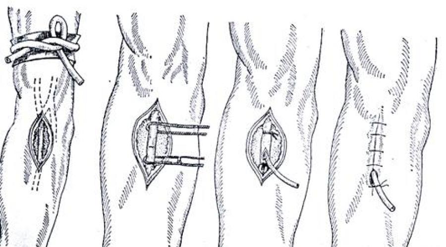 Катетеризация бедренной вены по сельдингеру. Техники катетеризации бедренной вены