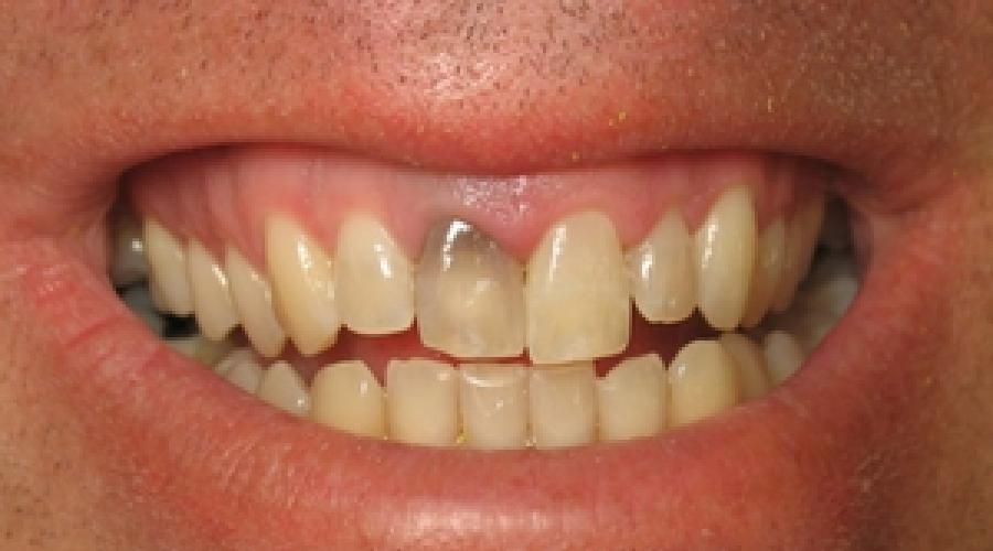 На зубе появилось темное пятно: причины, осложнения, лечение. Черные или коричневые точки на зубах — что это: как избавиться от темных пятен и полосок в домашних условиях