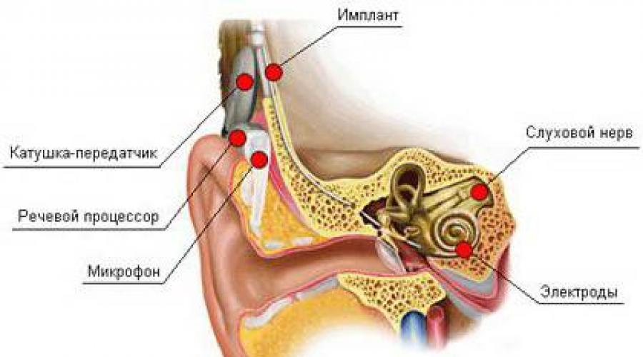Имплант слуховой аппарат. Слуховые импланты возвращают слух даже глухим от рождения