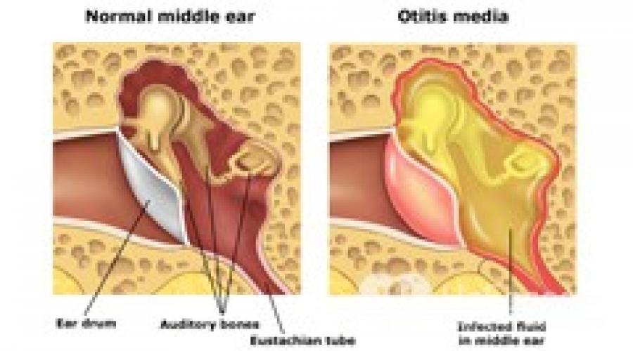 Отит уха симптомы и лечение. Отит: простое заболевание с трудными осложнениями