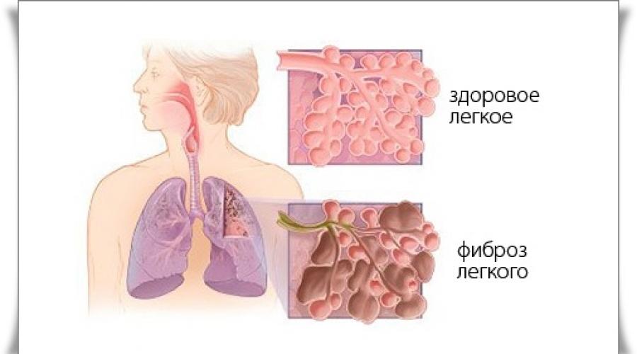 Заразен ли фиброзно-кавернозный туберкулез легких. Фиброзно-кавернозный туберкулез: симптомы, диагностика и лечение Фиброзно кавернозный туберкулёз легких