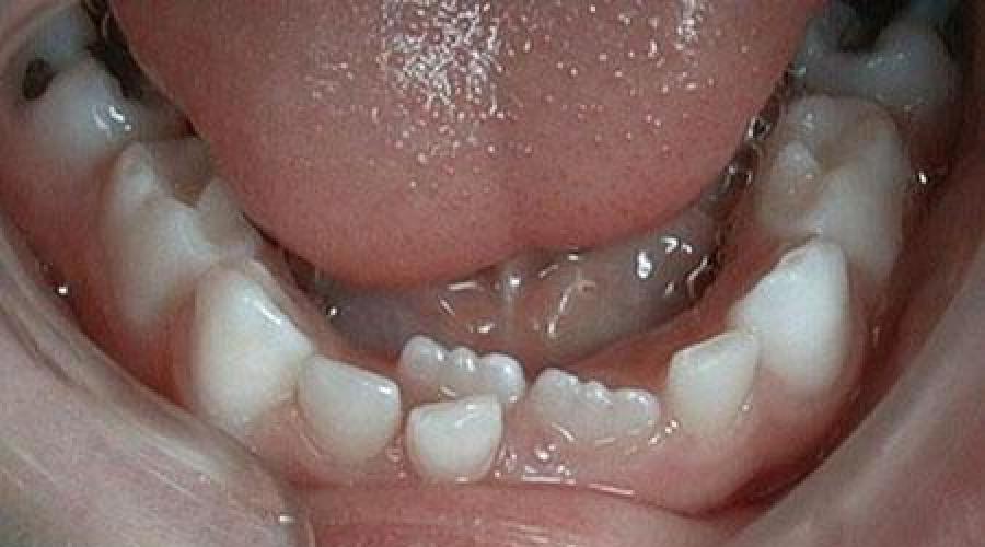 У детей молочные зубы меняются на постоянные. Сроки выпадения молочных зубов