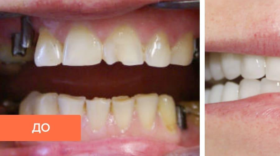 Все про зубные протезы. Съемные зубные протезы при частичном отсутствии зубов: какие лучше? Виды конструкций в зависимости от способа крепления