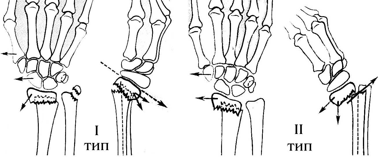 Место кости. Переломы лучевой кости в типичном месте типа коллеса и Смита. Типы переломов лучевой кости в типичном месте. Типы переломов луча в типичном месте. Перелом лучевой кости в типичном месте.