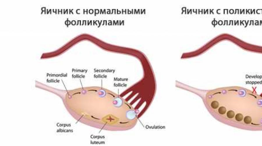 Кистозное изменение яичников: причины и лечение. Синдром истощения яичников