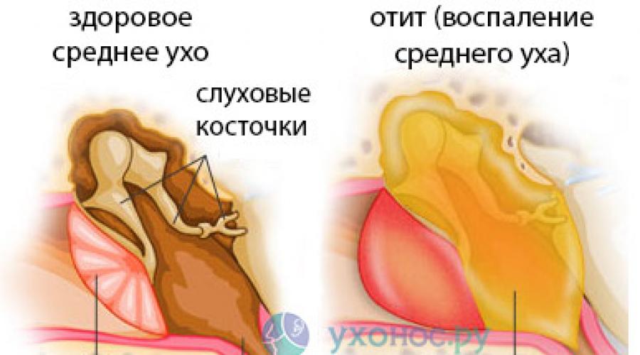 Из уха течет жидкость: что делать и чем лечить в домашних условиях. Как вылечить гнойный отит дома