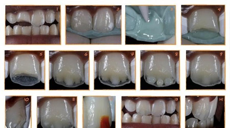 Реставрация зубов: обзор технологий восстановления. Реставрация передних зубов: «до» и «после