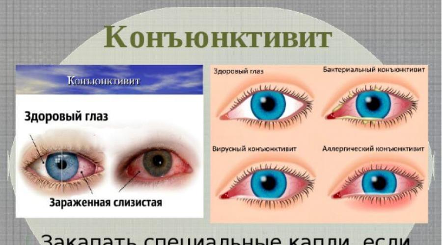 Конъюнктивит лечение в домашних. Вирусный и бактериальный конъюнктивит. Симптомы конъюнктивита глаз.