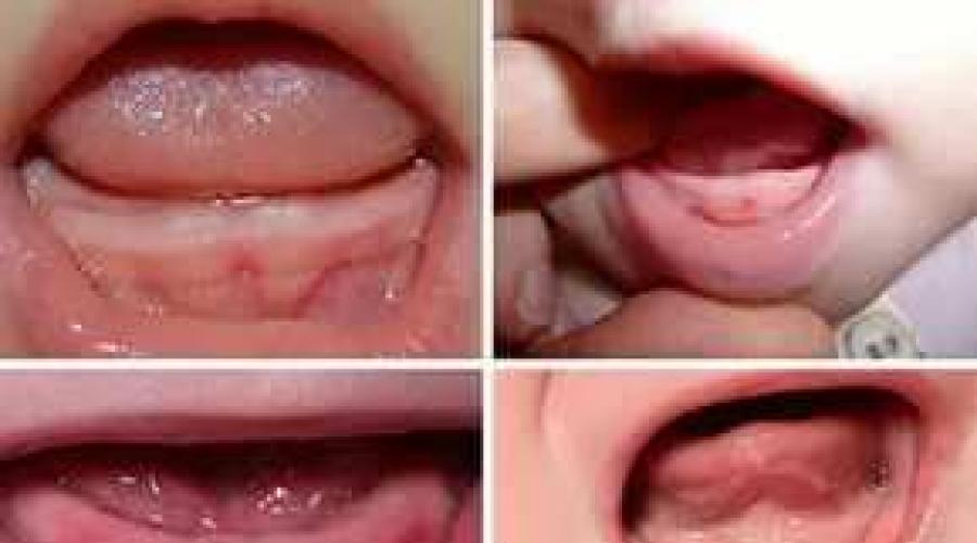 Как помочь ребенку, когда режутся первые зубы. Режутся зубки? Как помочь ребенку