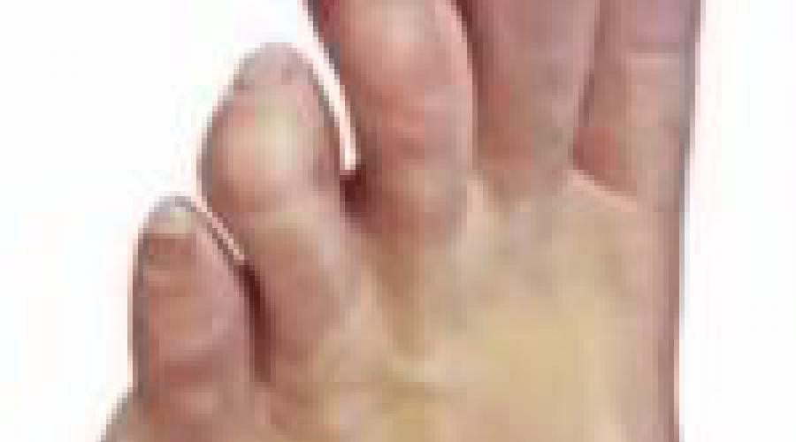 Чем убрать мозоль на пальце ноги болит. Сухая мозоль на мизинце ноги – лечение мазями и кремами