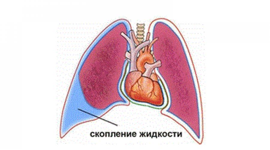 Жидкость в легких причины. Скопление жидкости в плевральной полости плеврит. Жидкость скапливается в легких. Серозный экссудат в плевральной полости. Серозная жидкость в плевральной полости.