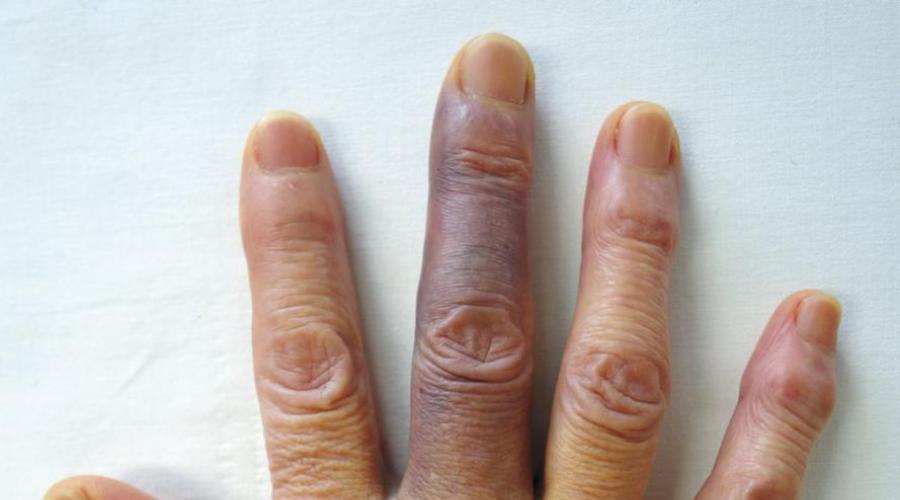 Почему может посинеть палец на руке? Посинел палец на руке: возможные причины и лечение. 
