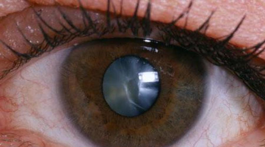 Вторичная катаракта. Лечение и цены