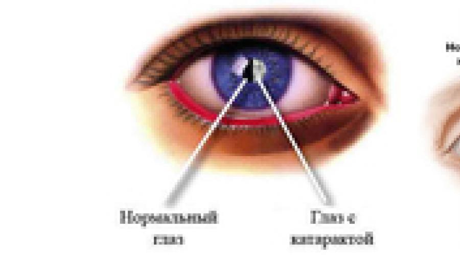 Катаракта оперативное лечение. Видео-материалы про удаление глазной катаракты
