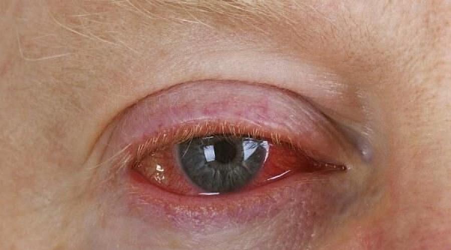 Инфекционные заболевания глаз – причины и лечение. Вирусные заболевания глаза