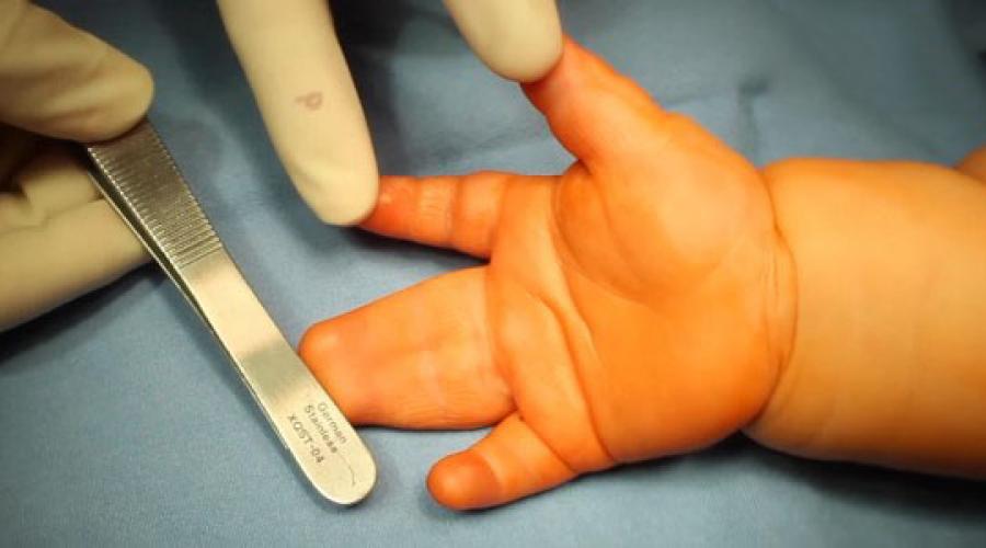 Сращение пальцев называется. Какие причины сросшихся пальцев на ногах у новорожденного? Лечение поражения пальцев
