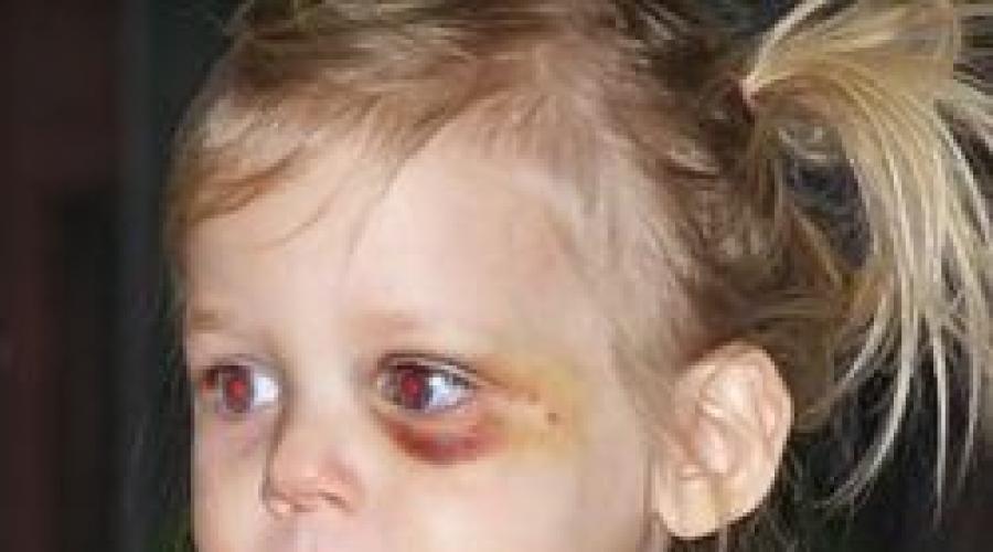 Синяки под глазами у ребенка 6 лет. Темные круги под глазами у ребенка