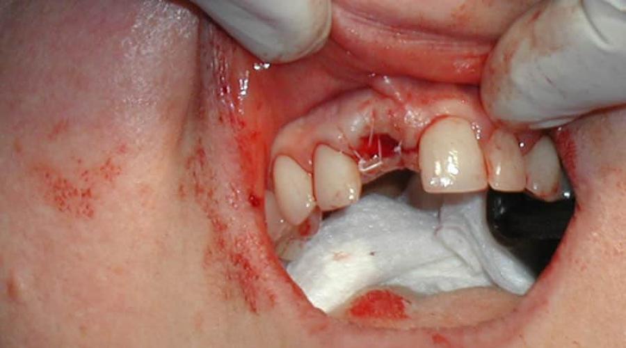 Почему кровоточит зуб после удаления. Как остановить кровь после удаления зуба мудрости