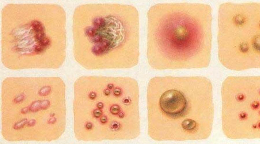Вирусная сыпь. Какие детские болезни сопровождаются сыпью на коже