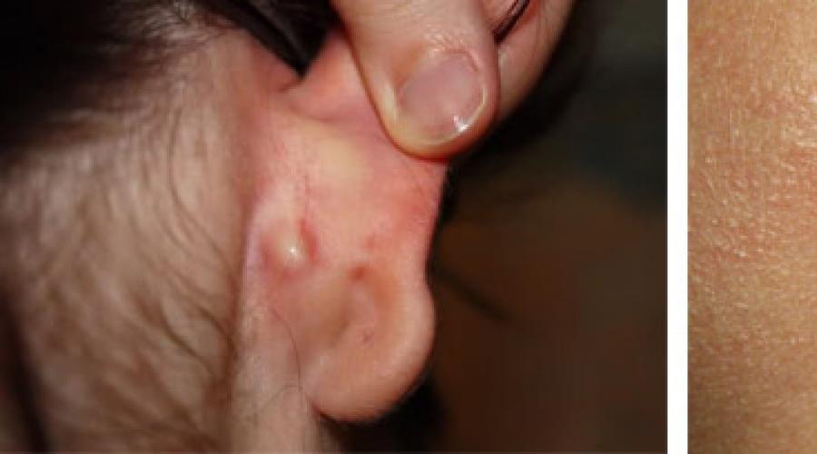 Образование шарика в мочке уха под кожей: причины и лечение. Уплотнение в мочке уха