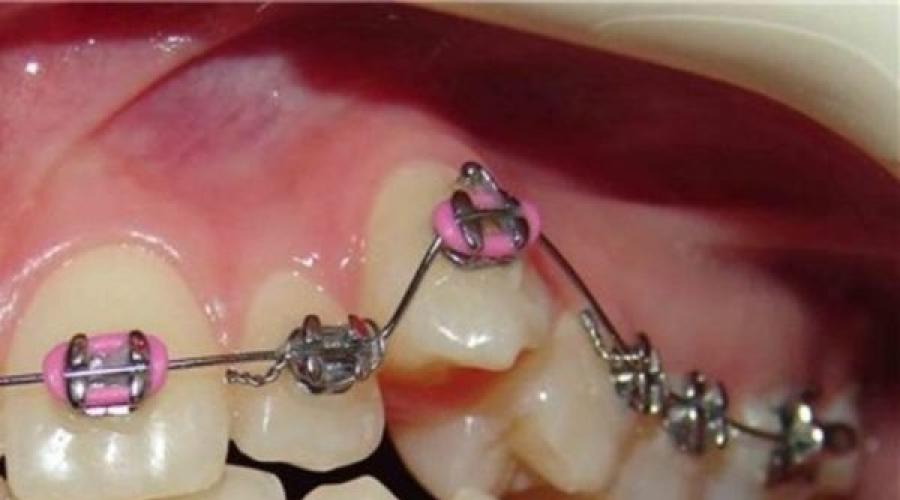 Что нужно делать с дистопированными зубами? Что такое дистопированный зуб: удаление и фото зубной аномалии. 