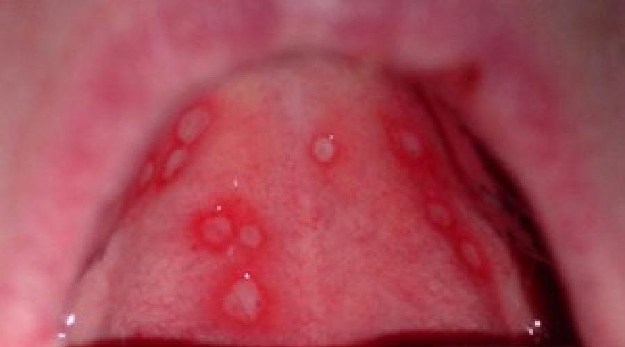 Средства от воспаления полости рта. Отек полости рта, лечение, причины