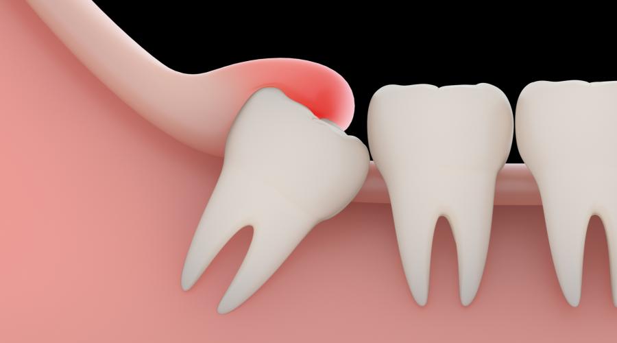 Воспаление зуба — как вовремя распознать периодонтит и приступить к лечению. Как снять воспаление зуба в домашних условиях
