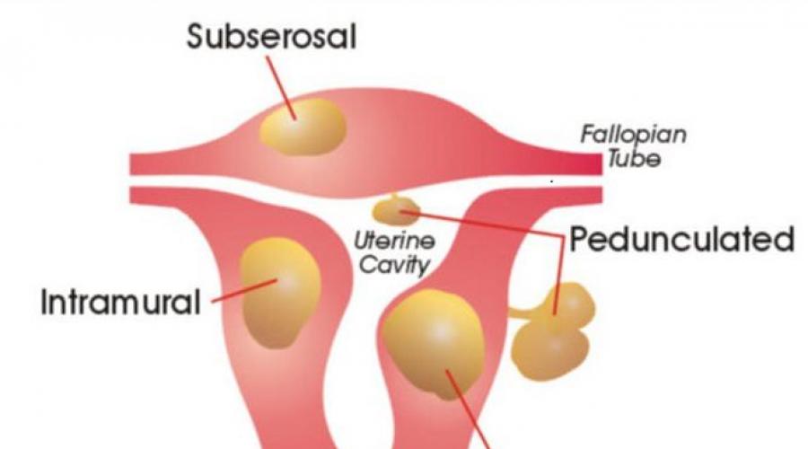 Фибромиома матки что это такое. Фиброма и фибромиома разница между. Фиброматоз матки симптомы.