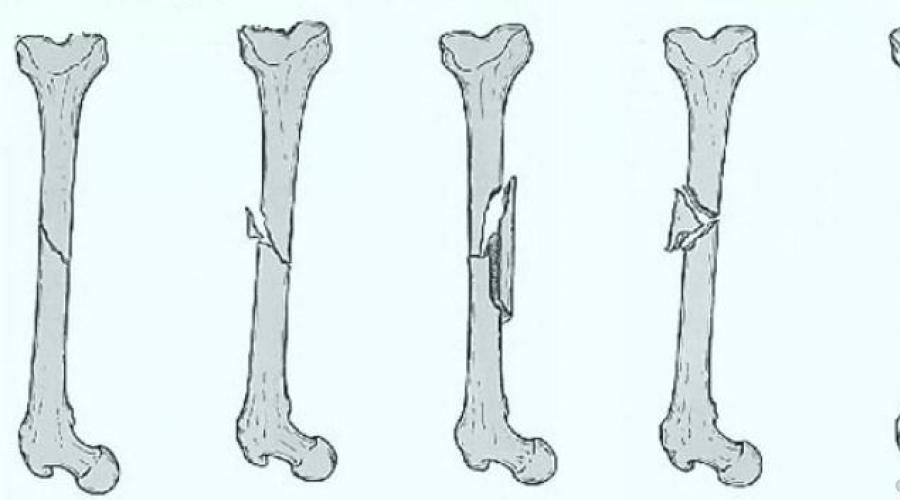 Рисунок перелома кости. Оскольчатый перелом кости. Поперечный оскольчатый перелом. Многооскольчатый перелом трубчатой кости. Оскольчатый перелом без смещения.