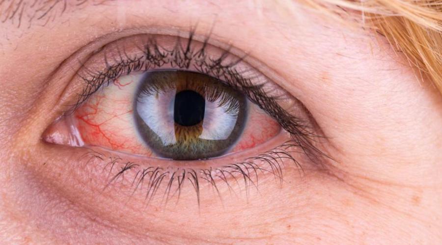 Красные пятна в глазу: причины проявления. Является ли предвестником болезни красное пятно в глазу