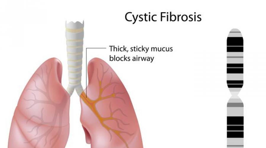В одной европейской популяции муковисцидоз. Муковисцидоз кистозный фиброз. Муковисцидоз этиология. Муковисцидоз патофизиология.