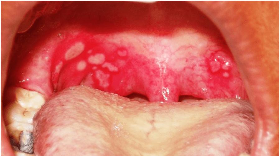  Лечение белых и красных волдырей в горле у взрослых и детей. 