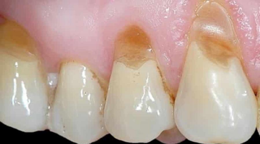 Современный подход к лечению клиновидных дефектов зубов. Причины и лечение клиновидного дефекта зубов в домашних условиях