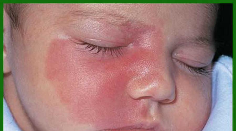 Сухие пятна на коже ребенка: причины развития, симптомы и лечение заболевания. Почему появляются красные шелушащиеся пятна на лице у женщин, детей, при беременности