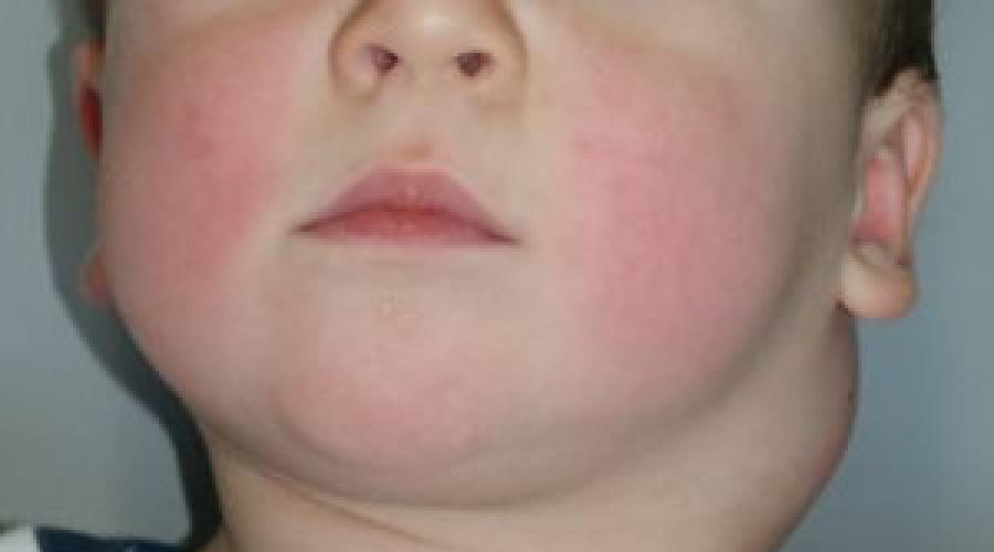 Воспаление лимфоузла на шее сзади у ребенка. Что делать, если у ребенка воспалился лимфоузел на шее